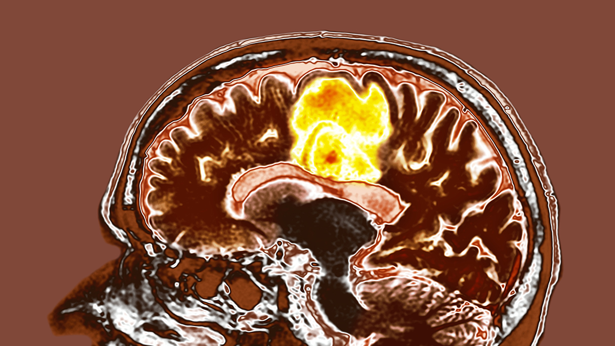 Featured image for Indian Study Finds Supplement Mix Effective Against Brain Cancer