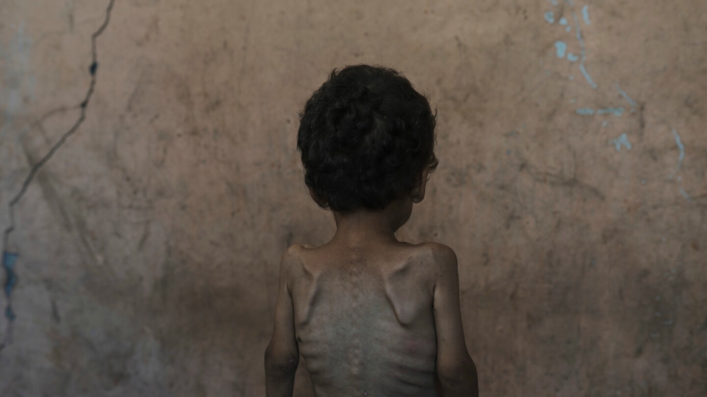 Featured image for Alarming Rise in Child Malnutrition and Casualties in Gaza Amid Ongoing Conflict