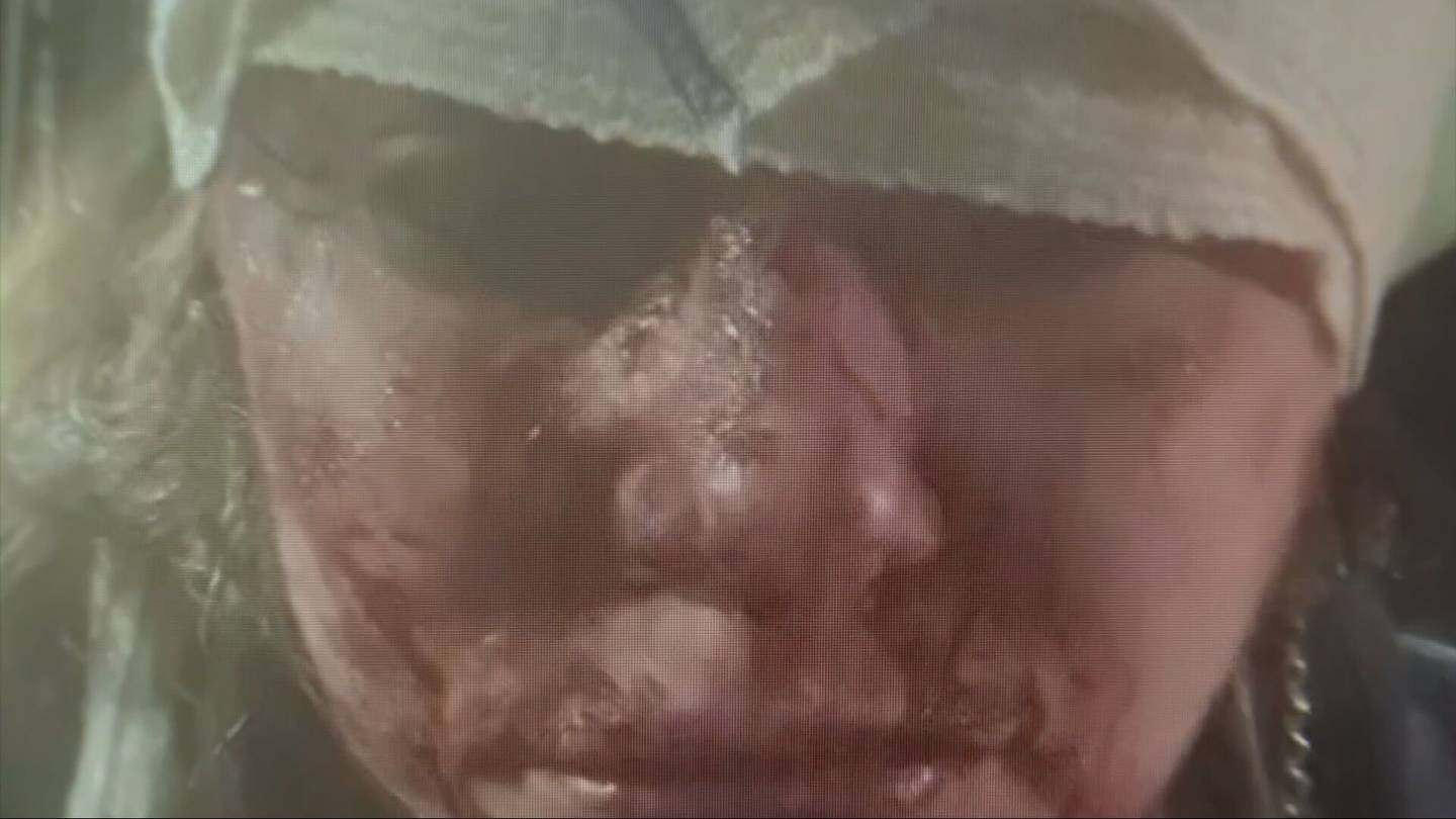 Featured image for Seattle Artist Contracts Flesh-Eating Bacteria in Random Park Attack