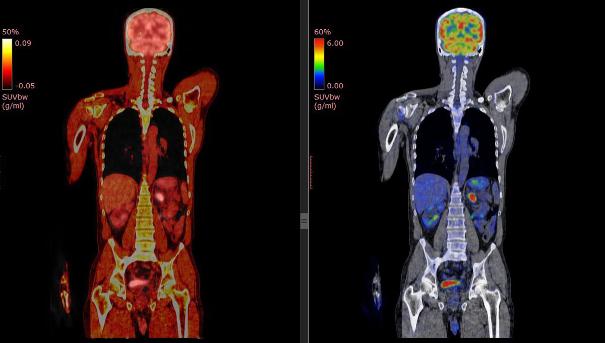 Featured image for "COVID Traces Persist in Body Years After Infection"