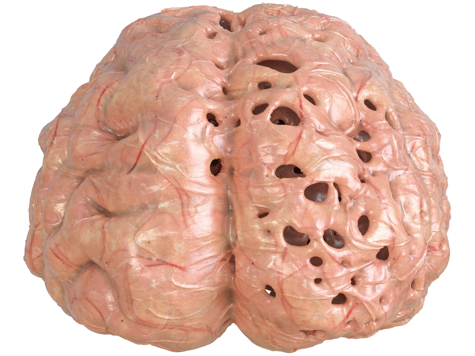 Sleep Apnea Linked to Reduced Brain Size, Study Finds.