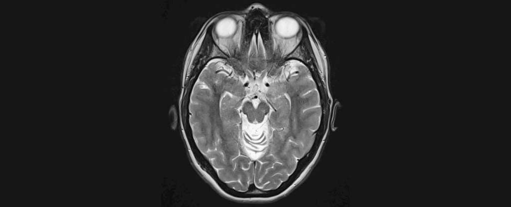 Featured image for AI Innovations Revolutionize Alzheimer's Diagnosis and Prediction