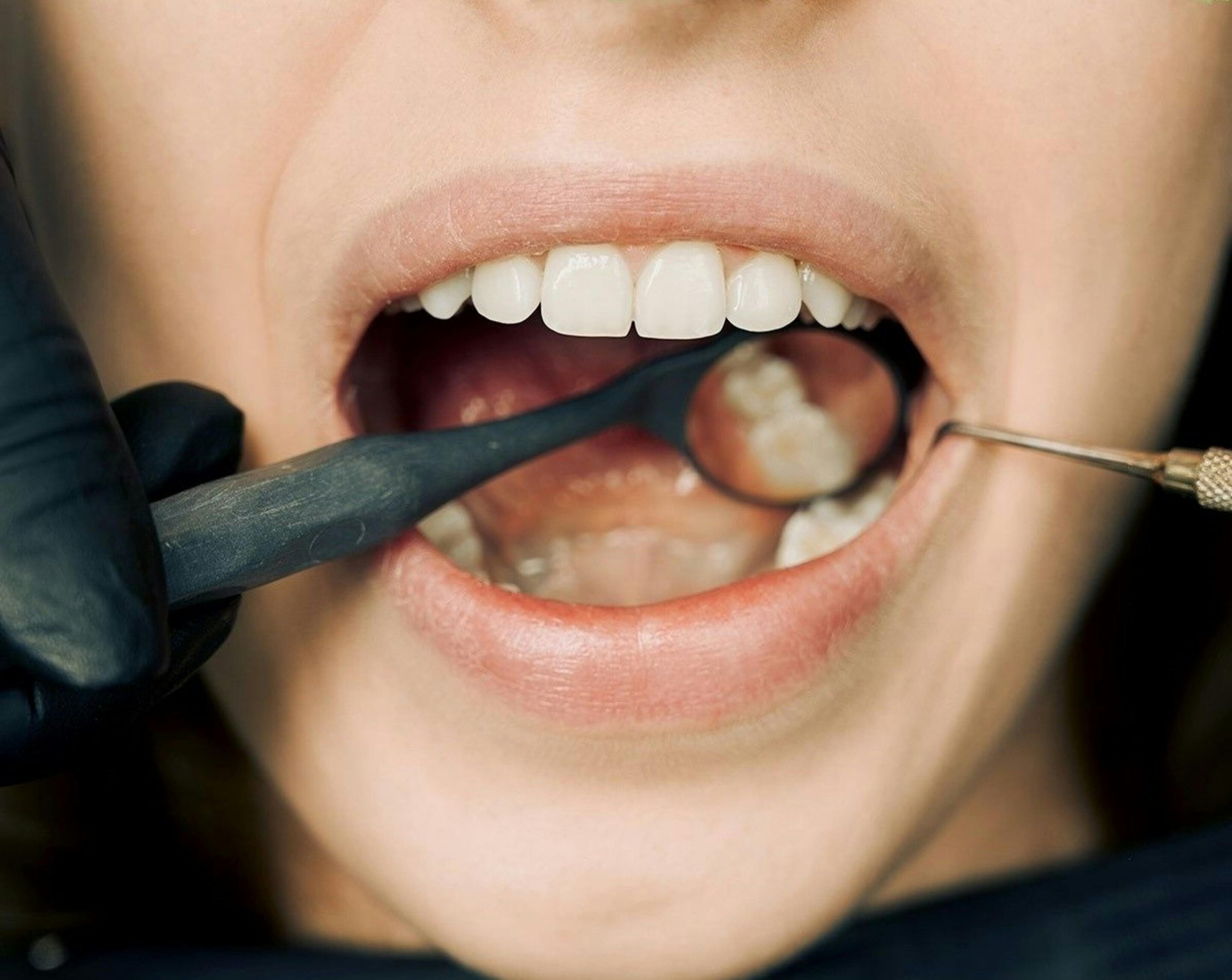Neanderthal Gene Found to Shape Modern Human Teeth