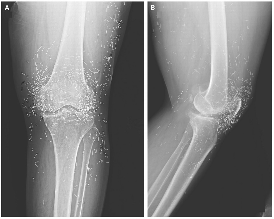 Featured image for Woman's Severe Knee Pain Uncovers 'Golden Threads' in Joints