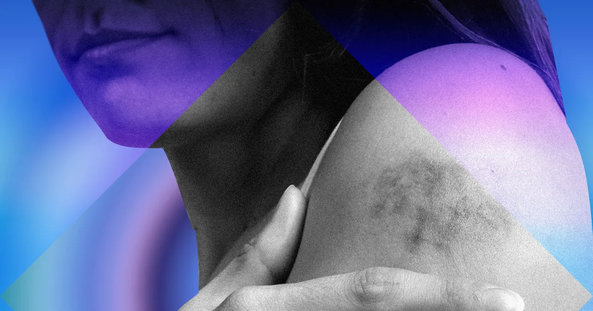 Featured image for Understanding Sudden Appearance of Purple Blotches on Skin.