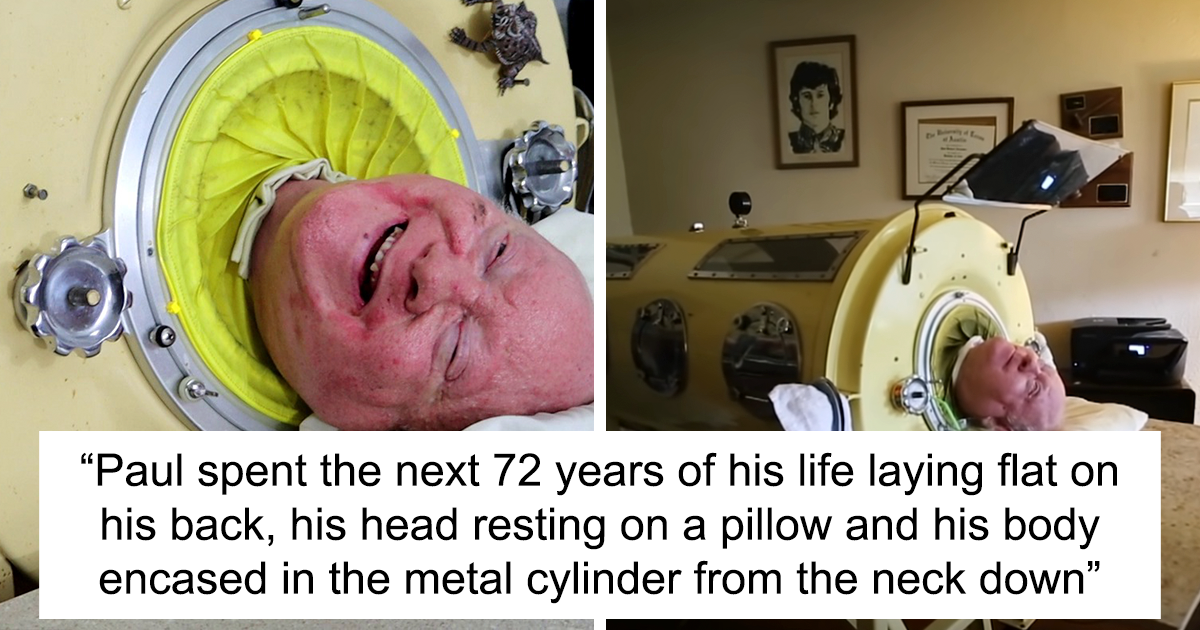 Featured image for "Polio Survivor Paul Alexander, Who Lived in Iron Lung for 70 Years, Passes Away at 78"