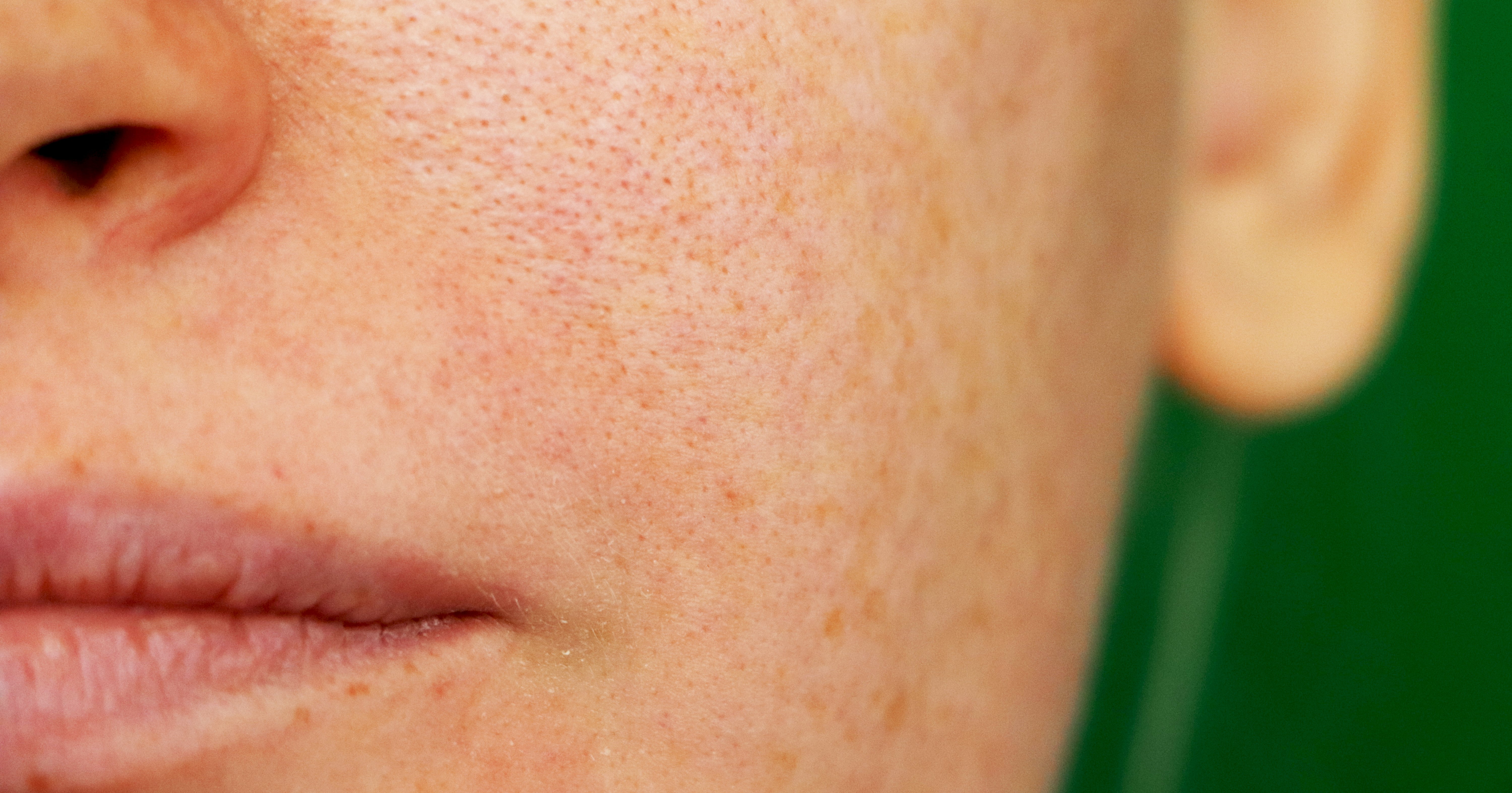 Featured image for Expert Advice on Treating and Managing Melasma