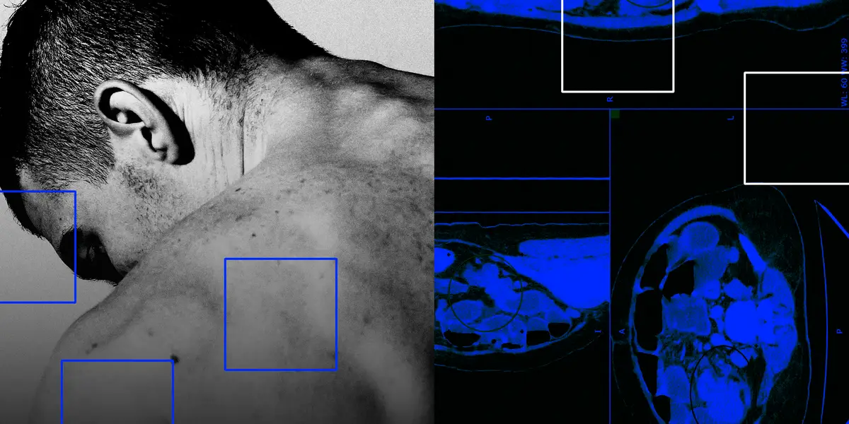 Featured image for Rising Colon Cancer Rates in Young Adults: Causes and Prevention
