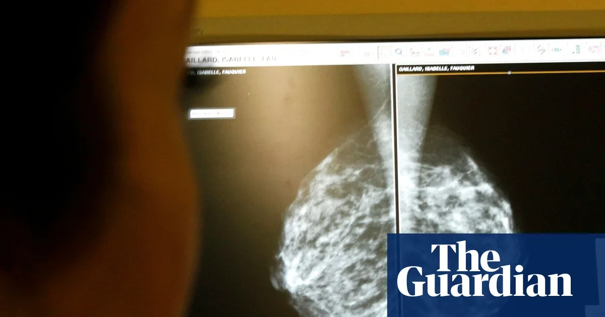 AI-assisted mammography cuts later breast cancer diagnoses by 12% in large Swedish trial