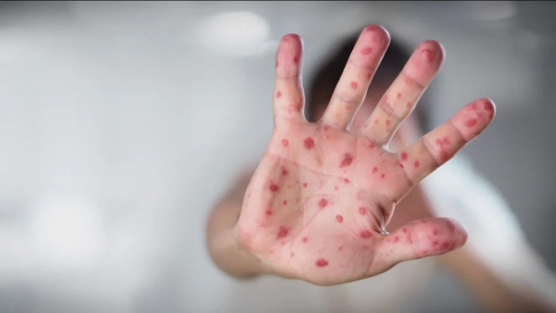 Two Vallivue students' measles exposure triggers Caldwell health alert