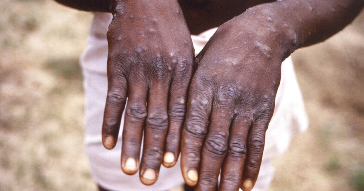 Featured image for Surge in Monkeypox Cases Raises Concern for Nashville Health
