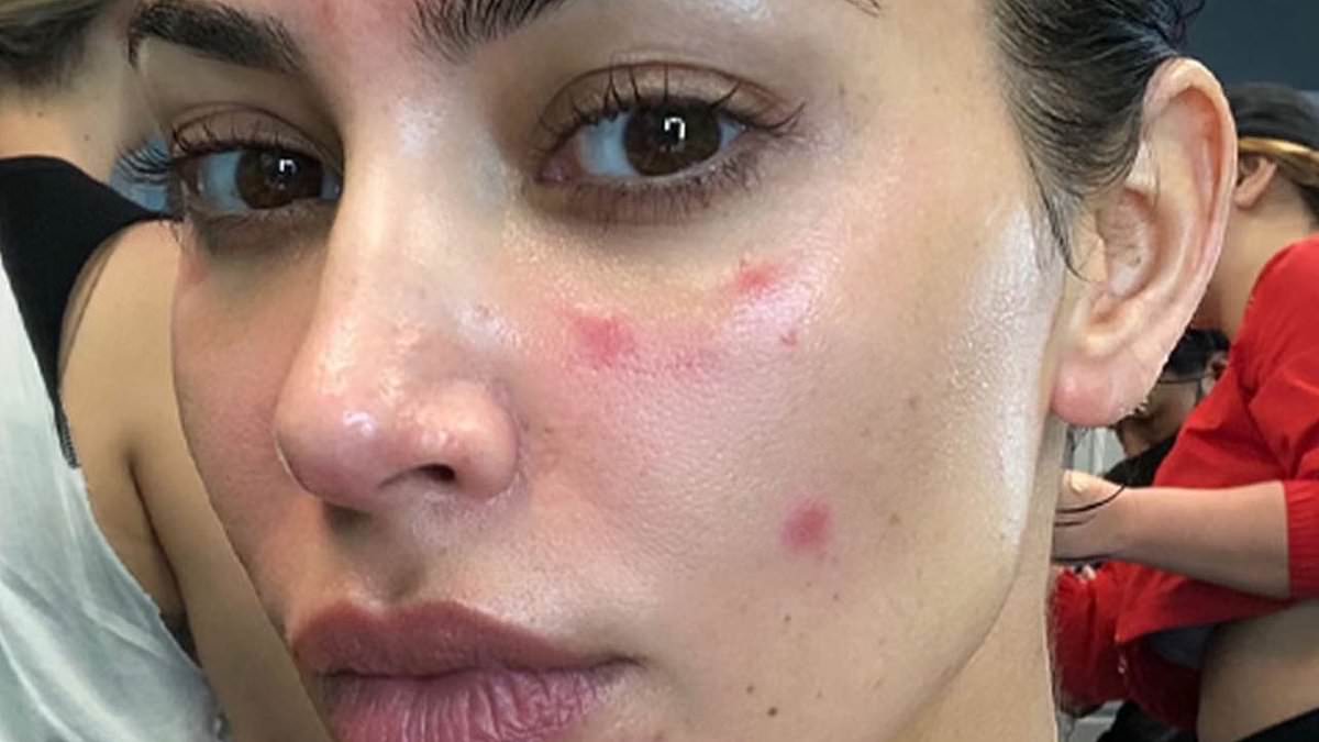 Kim Kardashian's Secret Battle with Adult Acne and Skincare Solutions