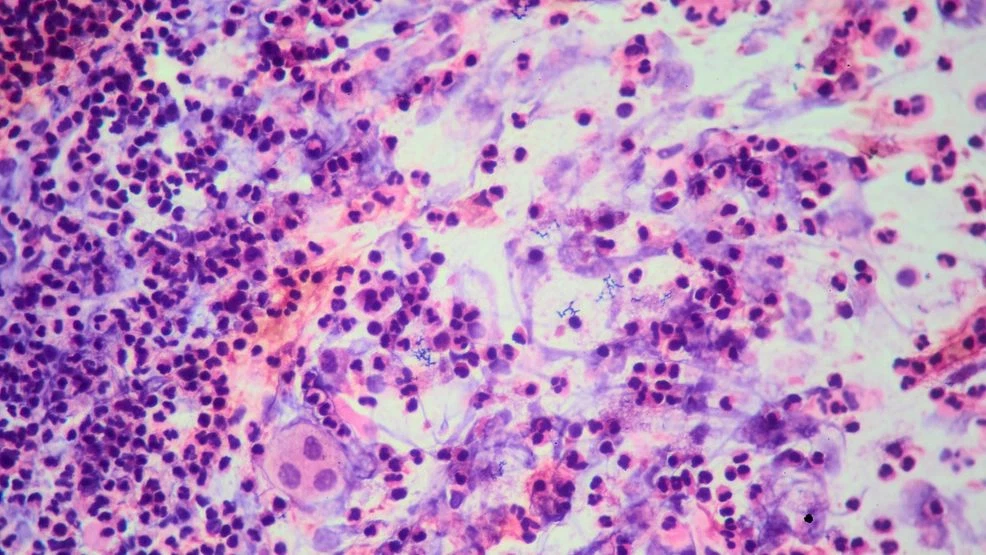 Featured image for Tuberculosis Cases Reported at Multiple Michigan High Schools