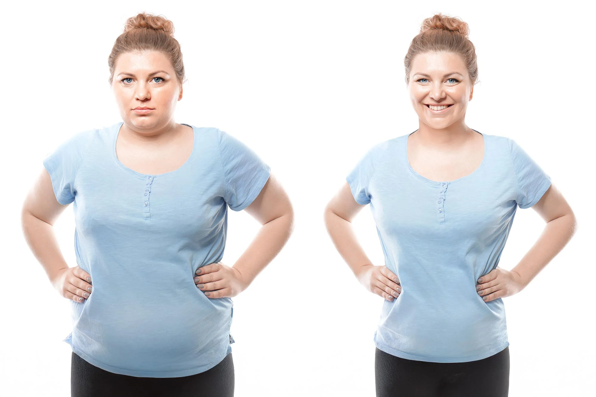 Intermittent Fasting Shows Promise for Managing Type 2 Diabetes in Obese Patients