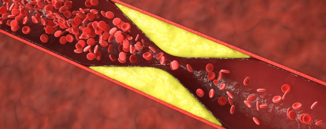 Featured image for Many Young Women’s Heart Attacks Not Caused by Blocked Arteries