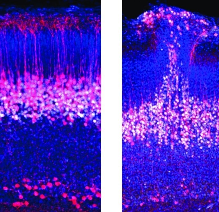 "Discovery of Embryonic Brain Circuit May Shed Light on Autism Development"