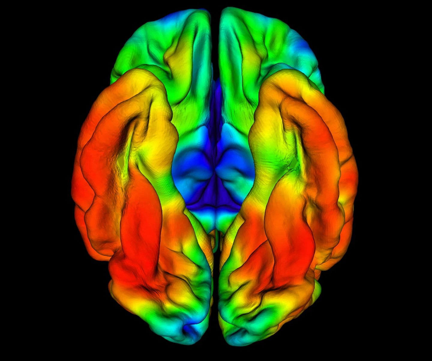 Rare gene mutation delays onset of Alzheimer's disease.