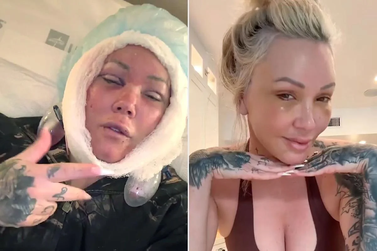 Bunnie Xo Opens Up About Painful Facelift Recovery and Supportive Comeback