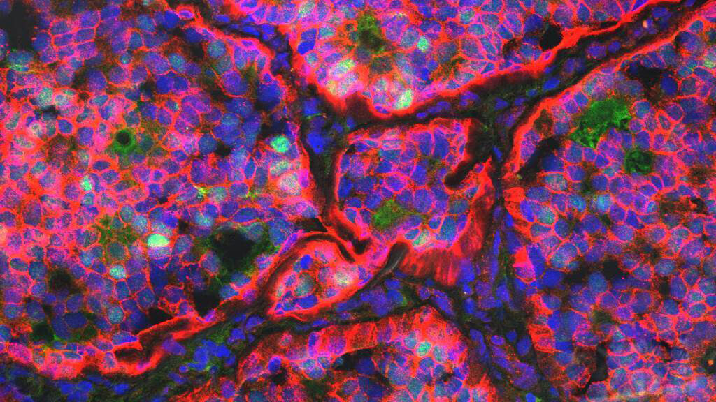Featured image for New Drug Combo Significantly Reduces Breast Cancer Progression Risk