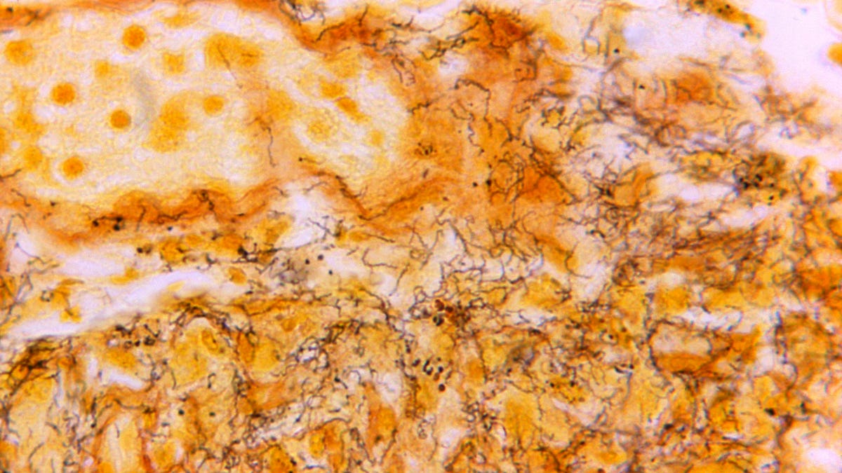 Featured image for Syphilis Resurgence Linked to COVID and Budget Cuts, CDC Reports