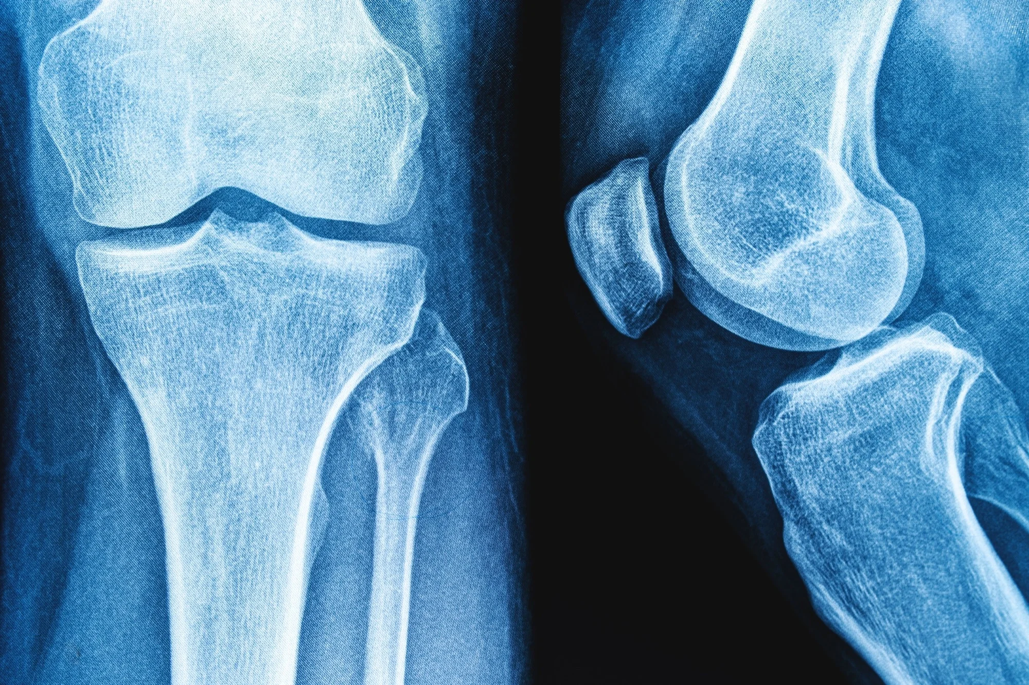 Featured image for Yogurt's Bone Benefits Do Not Prevent Fractures, Study Finds