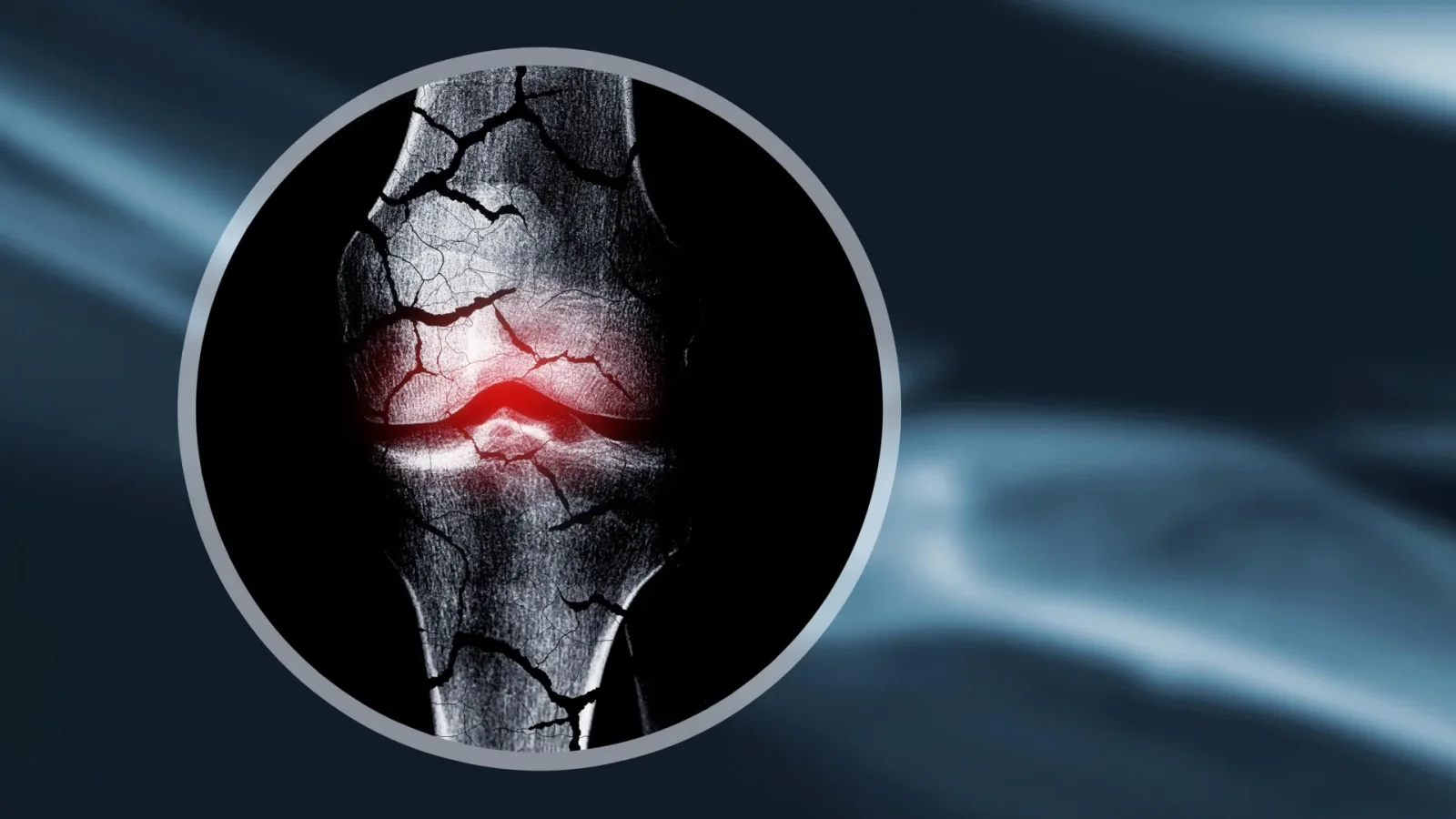 Off-the-shelf cartilage scaffold guides bone regrowth