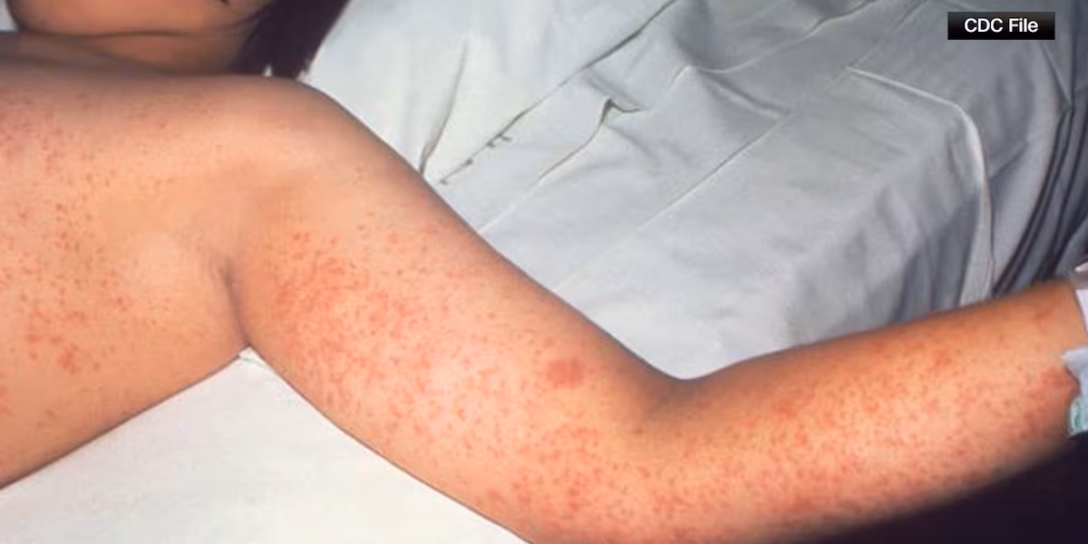 Featured image for Measles Outbreaks Rise in the US, Including Colorado, with New Exposure Sites