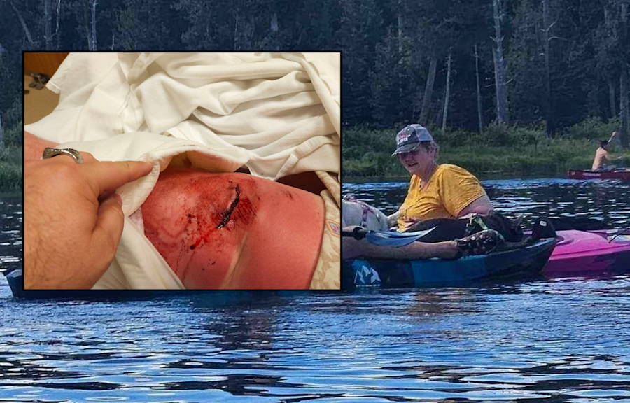 Featured image for Survivor: Woman Battles Flesh-Eating Disease After Waterfall Accident