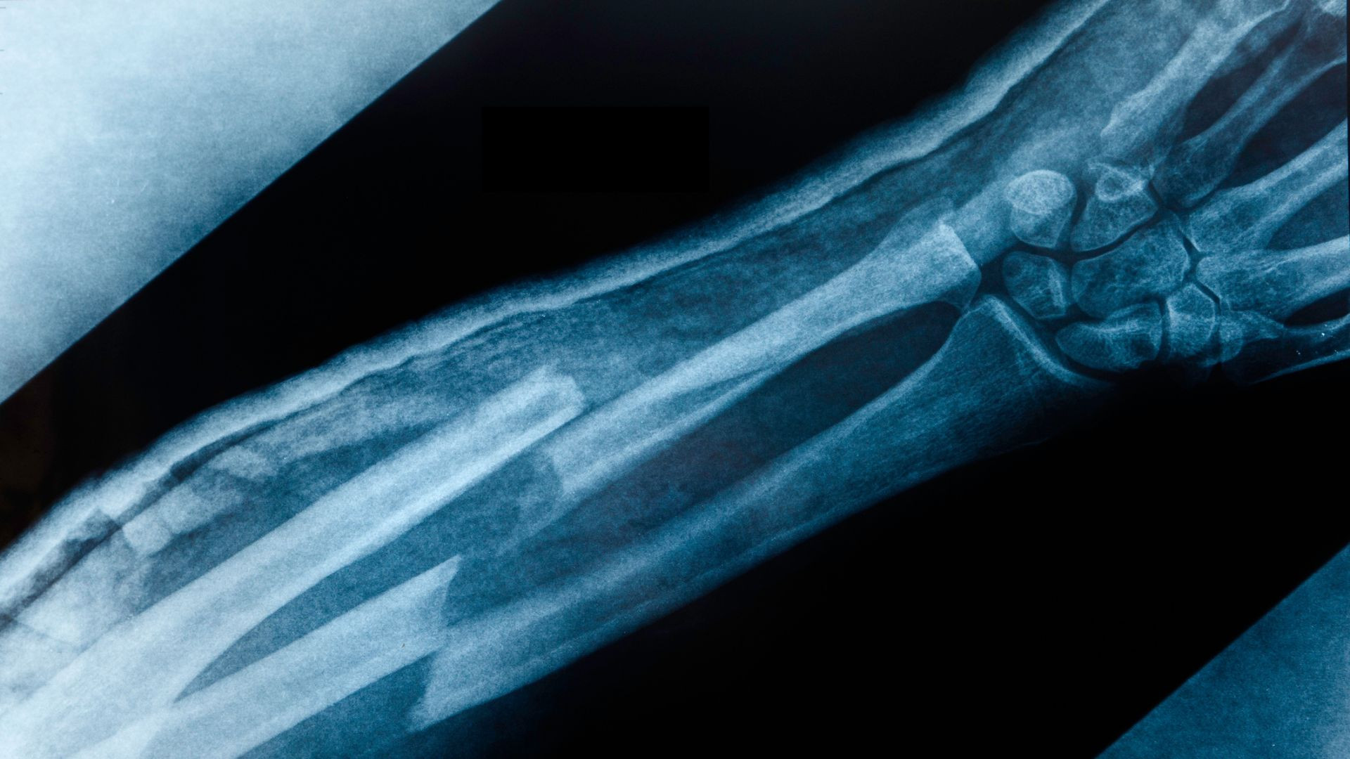 Featured image for "Novel Piezoelectric Bandage Accelerates Bone Healing"