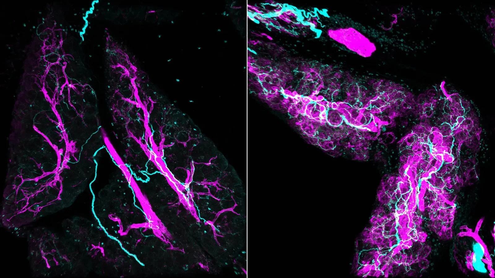 Nerve-Fibroblast Loop Spurs Early Pancreatic Cancer Growth