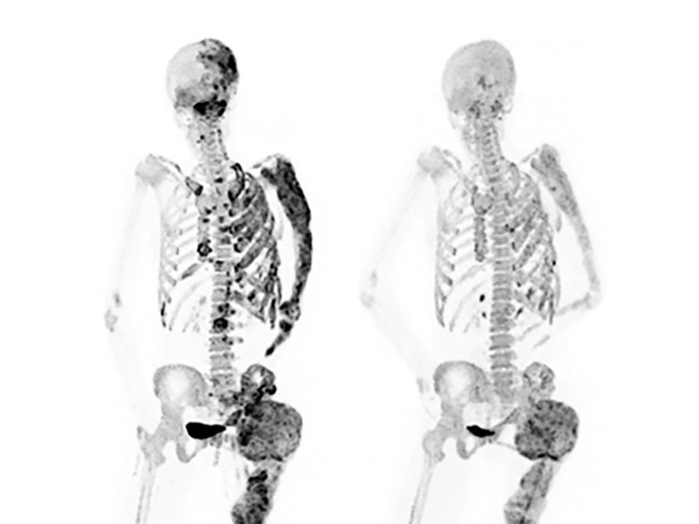 Featured image for NIH Clinical Trial Shows Promise for Rare Bone Disorder Treatment
