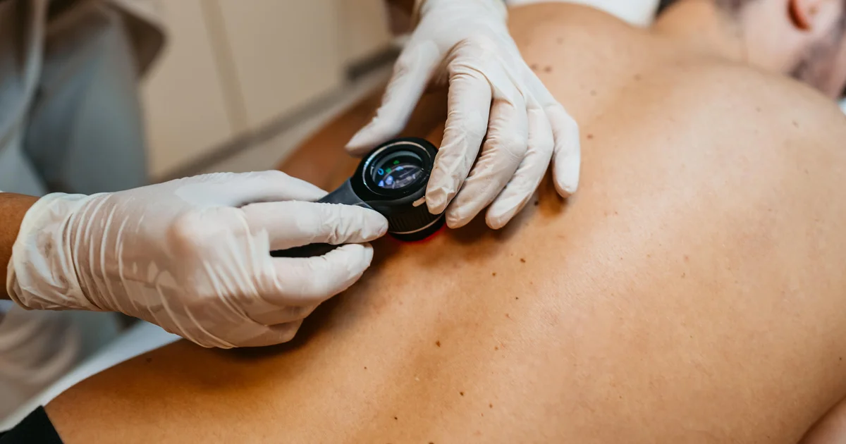 "Melanoma Monday: Expert Tips for Skin Cancer Prevention and Sun Safety"