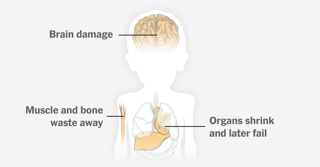 Featured image for Alarming Rise in Child Malnutrition in Gaza Amid Ongoing Conflict