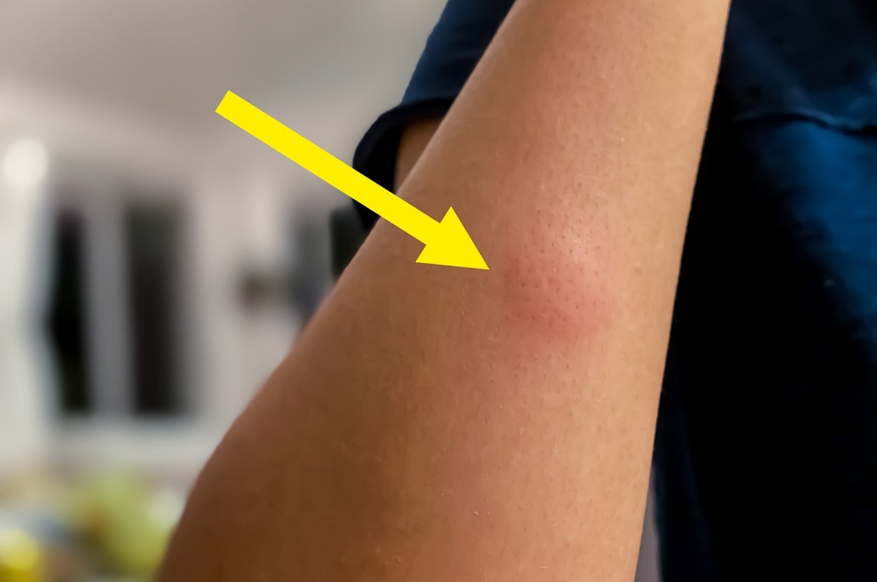 Featured image for Avoid This Mistake After a Mosquito Bite