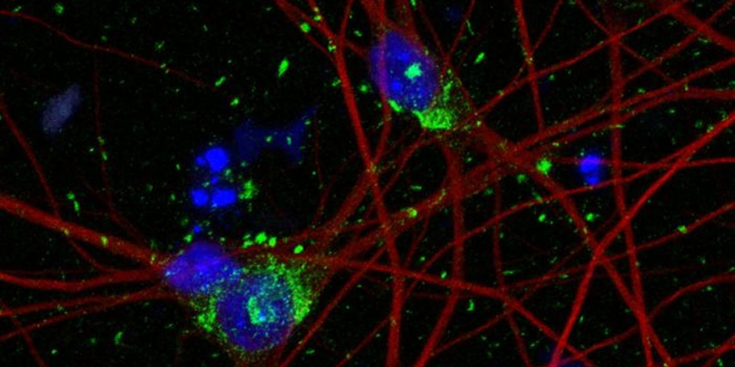 Featured image for "Human Neuron Model Unlocks Potential Breakthrough in Alzheimer's Treatment"