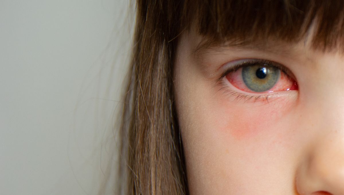 Featured image for Possible Link Between COVID-19 Variant and Pink Eye, Warns Health Officials