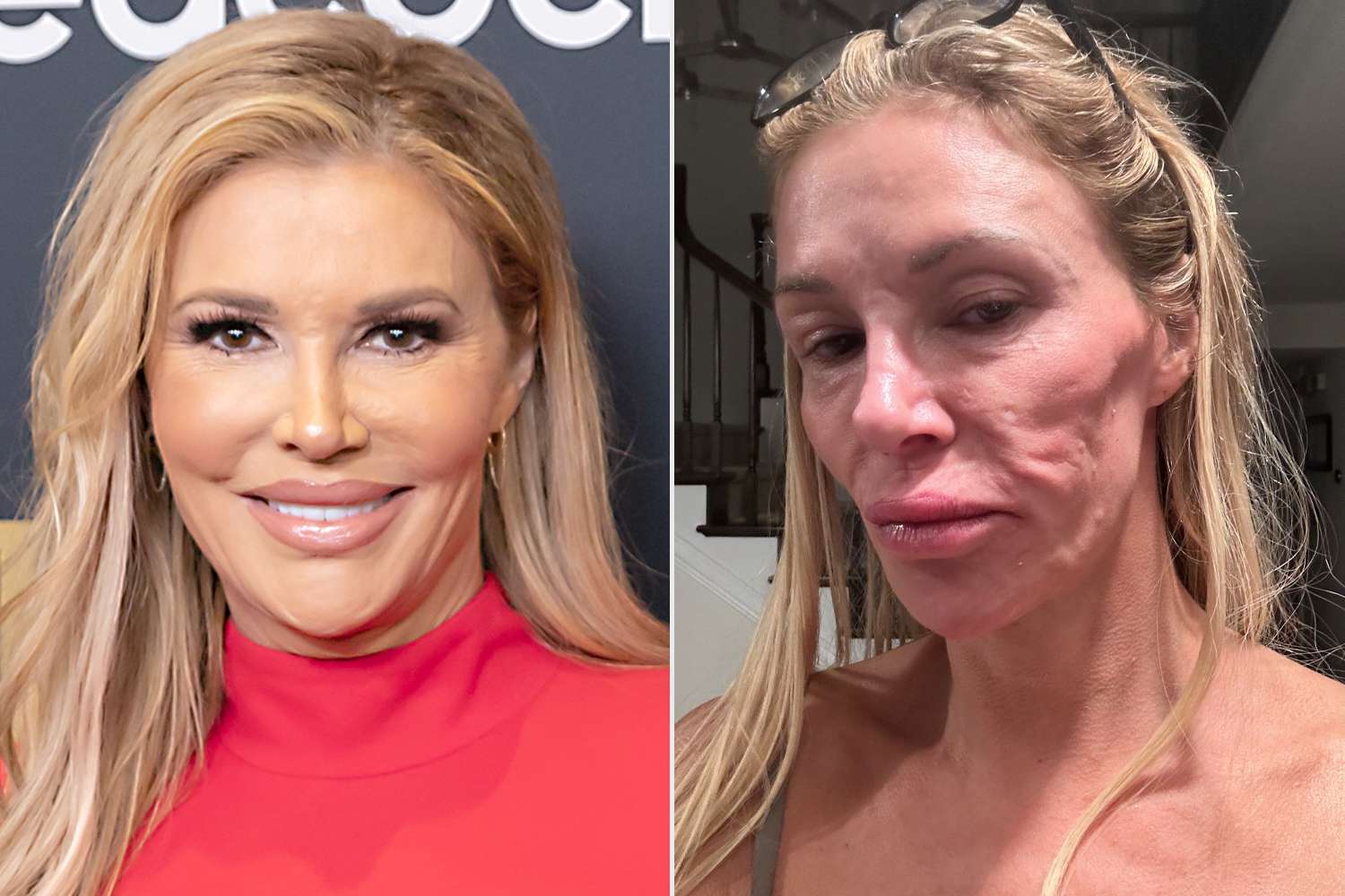 Featured image for Brandi Glanville's Health Scare: Face Parasite or Misdiagnosis?
