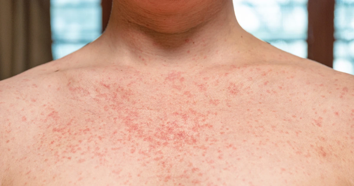 "CDC Warns of Renewed Threat to Measles Elimination in the US"