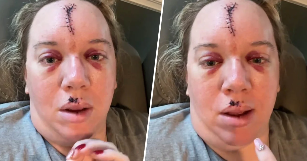 Featured image for "Fainting Incident Leaves Woman with Permanent Facial Scar: A Cautionary Tale"