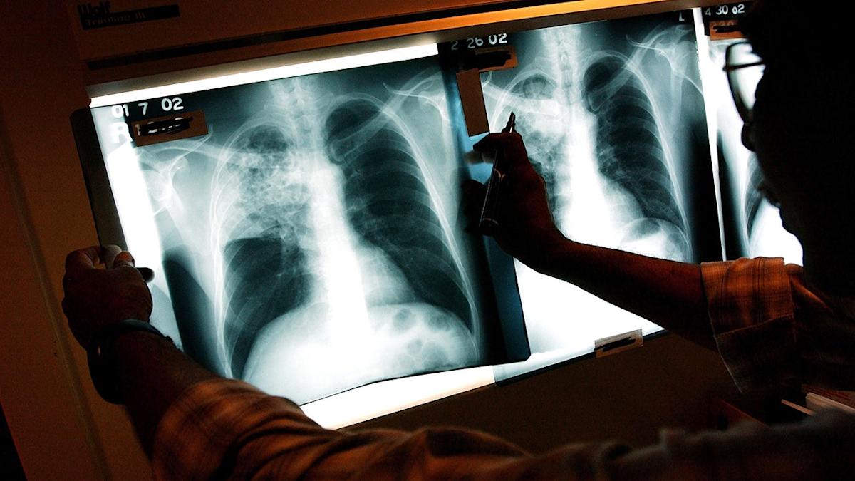 Featured image for Maine Reports Three Active Tuberculosis Cases Amid Rising National Cases