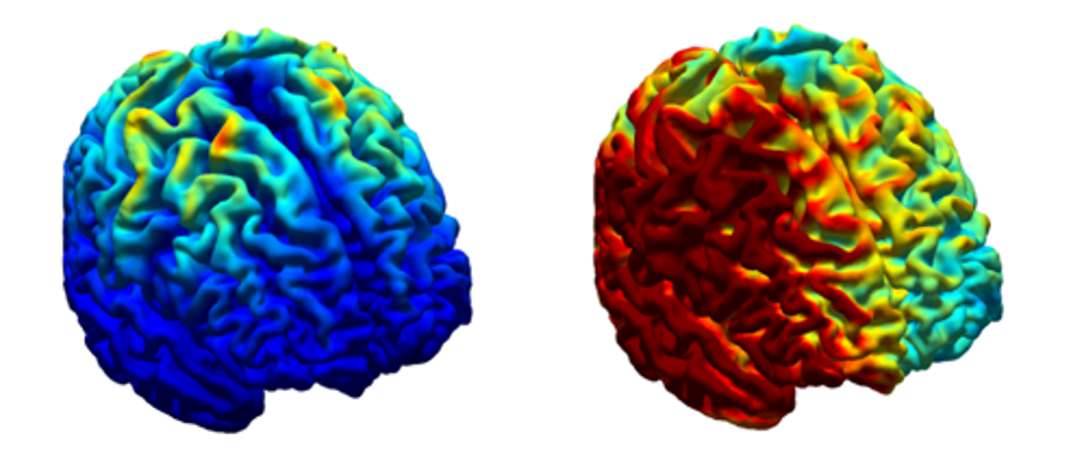 Featured image for Comparing the Effectiveness of Magnetic Seizure Therapy and Electroconvulsive Therapy for Depression Treatment