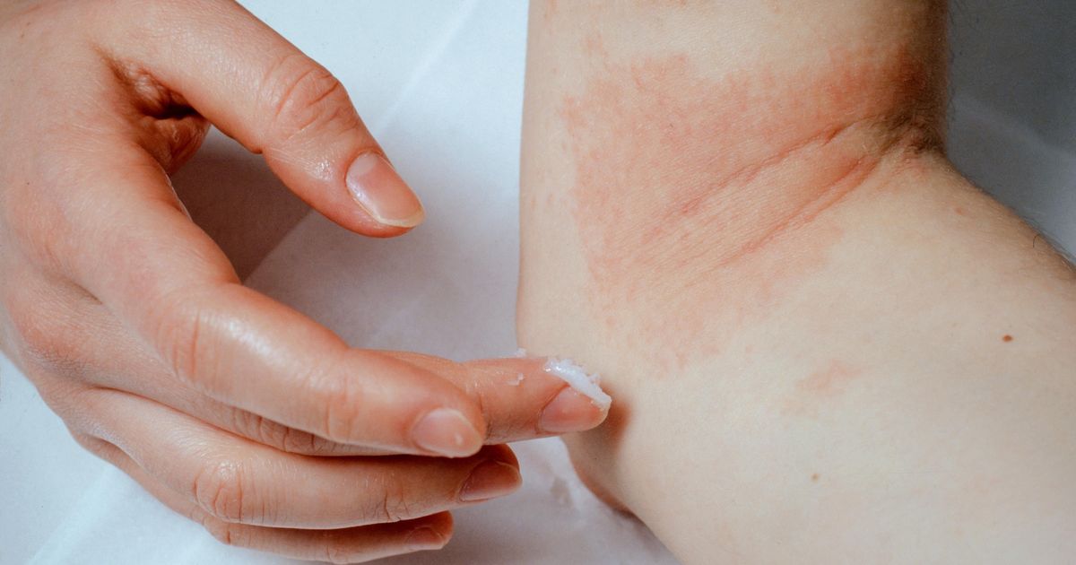 "Effective Products and Tips for Managing Atopic Eczema"