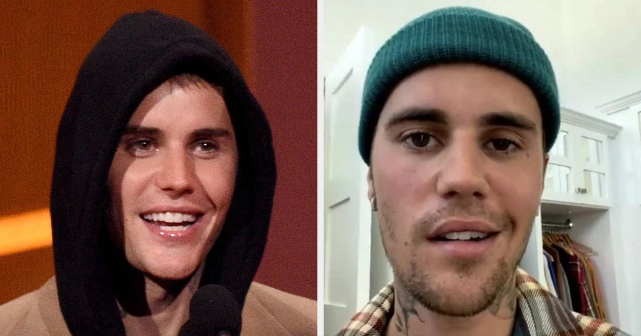 Justin Bieber's Facial Paralysis Recovery Update