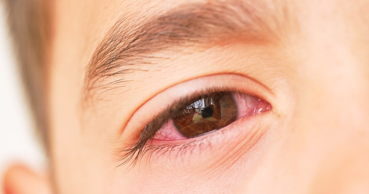 Featured image for The Rise of Arcturus: A New COVID Variant to Watch