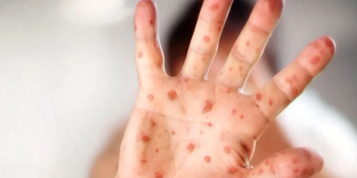 Airport measles exposure triggers public health alert in Phoenix