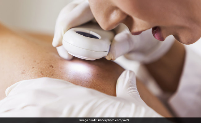 Rising Deaths from Non-Melanoma Skin Cancer Surpass Melanoma