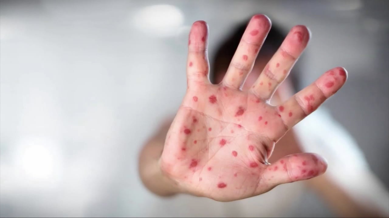 Featured image for Measles Outbreak Prompts Health Alert in Southwest Washington and Oregon