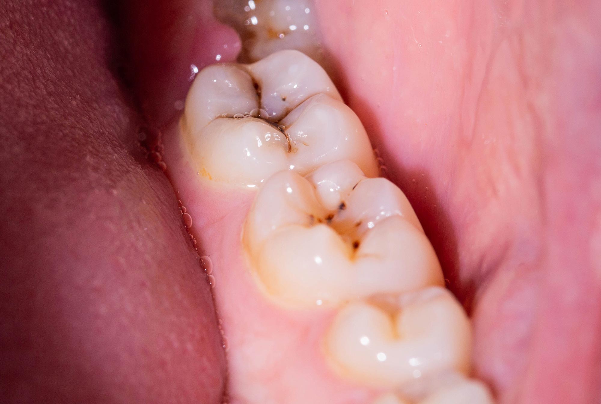 "Revolutionary Liquid Prevents 80% of Cavities in Kids"
