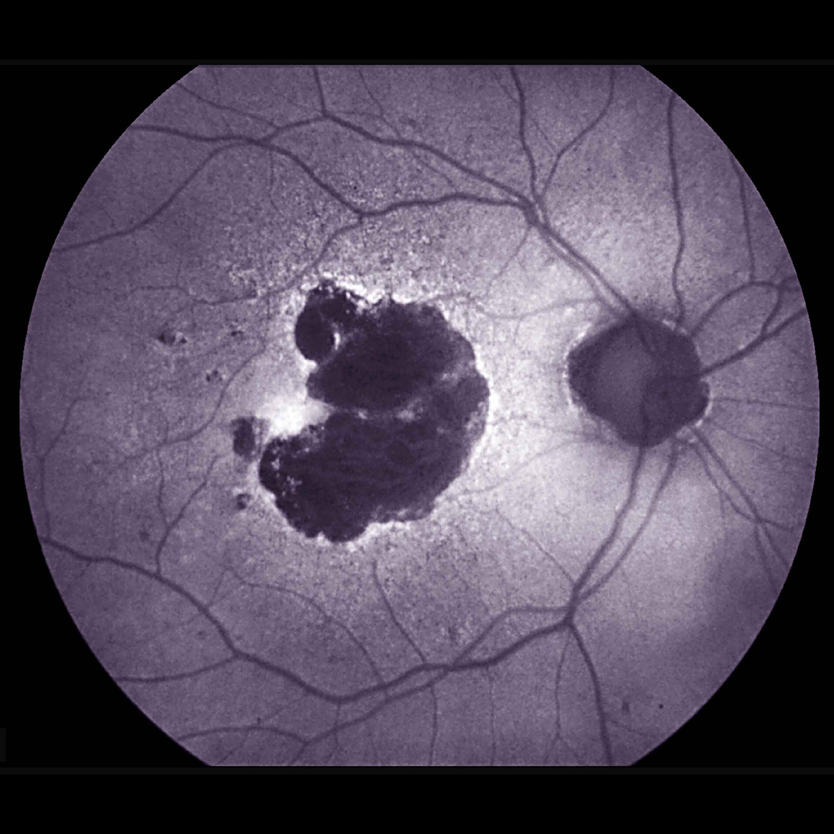 Featured image for "Inflammation-Reducing Drug Ineffective for Dry Age-Related Macular Degeneration, NIH Trial Finds"