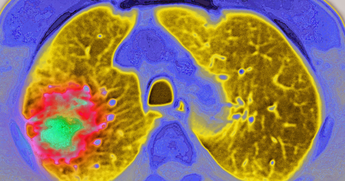 Featured image for Pfizer's Lorbrena Shows Breakthrough Results in Advanced Lung Cancer Trials